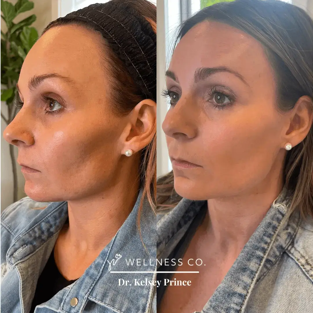 Before and After Photo | IPL, Neuromodulator, Sculptra | Wellness Co. | Zeeland, MI
