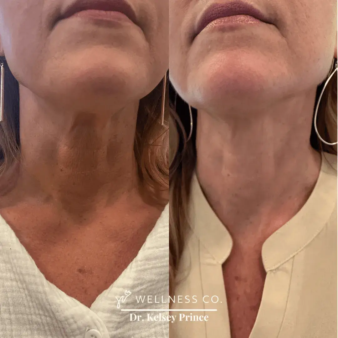 Before and after Photo | Neck lines reduction treatment | Wellness Co. | Zeeland, MI