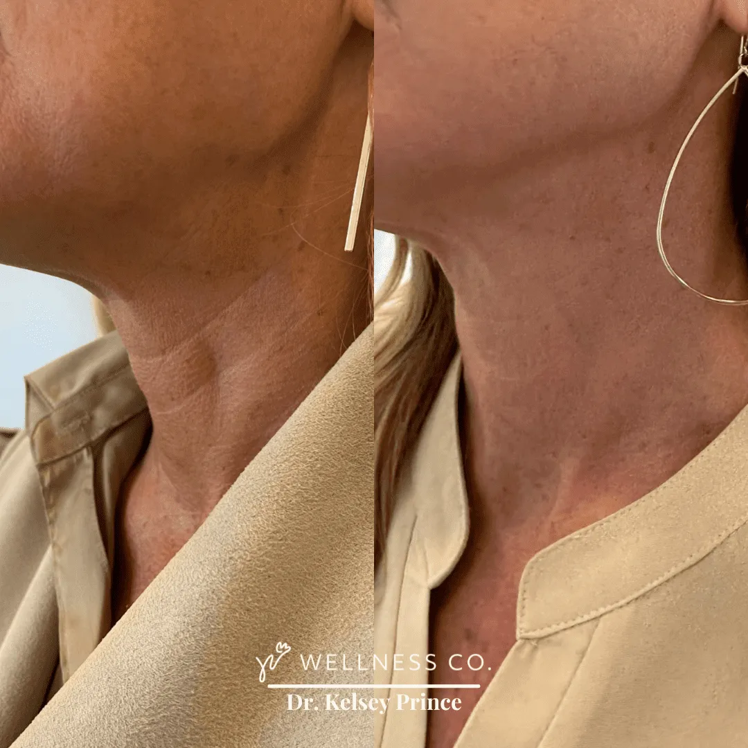 Before and after Photo | Radiesse | Neck lines | left side pose | Wellness Co. | Zeeland, MI
