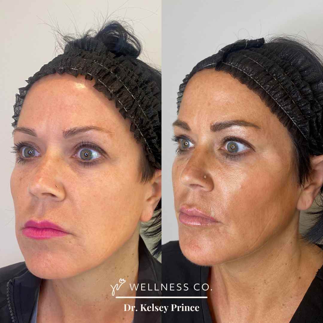 Before and after Photo | Sculptra for face | Wellness Co. | Zeeland, MI