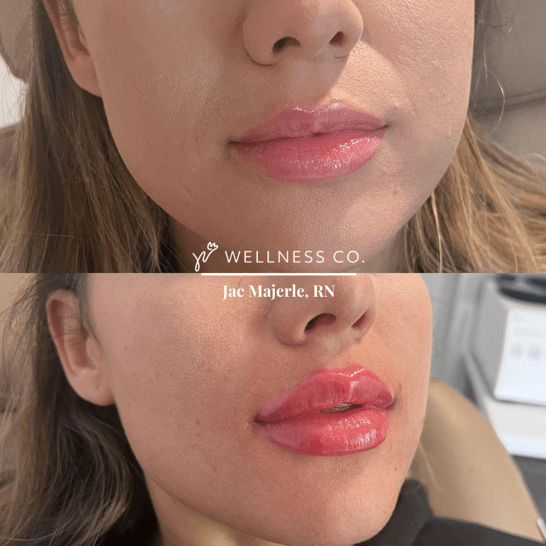Before and after Photo | Lip Filler 6 | Wellness Co. | Zeeland, MI
