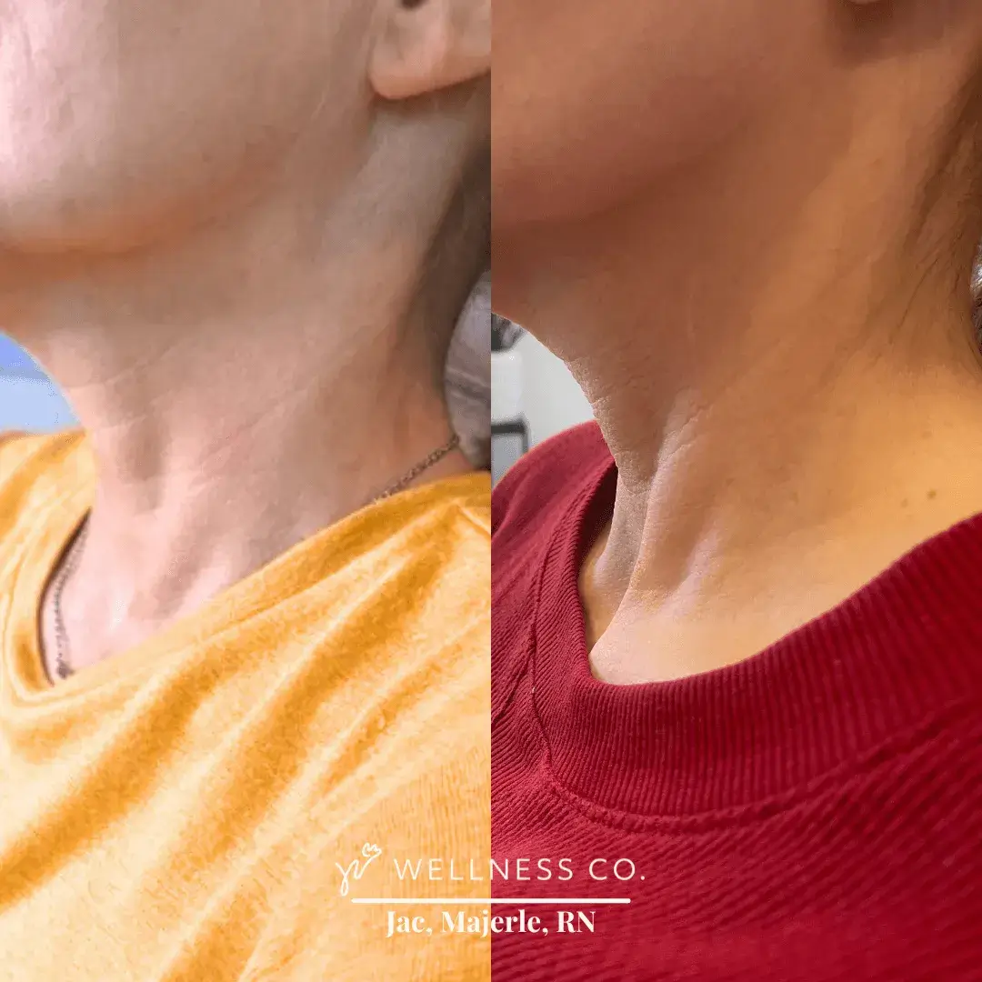 Before and after Photo | Radiesse for neck | Wellness Co. | Zeeland, MI