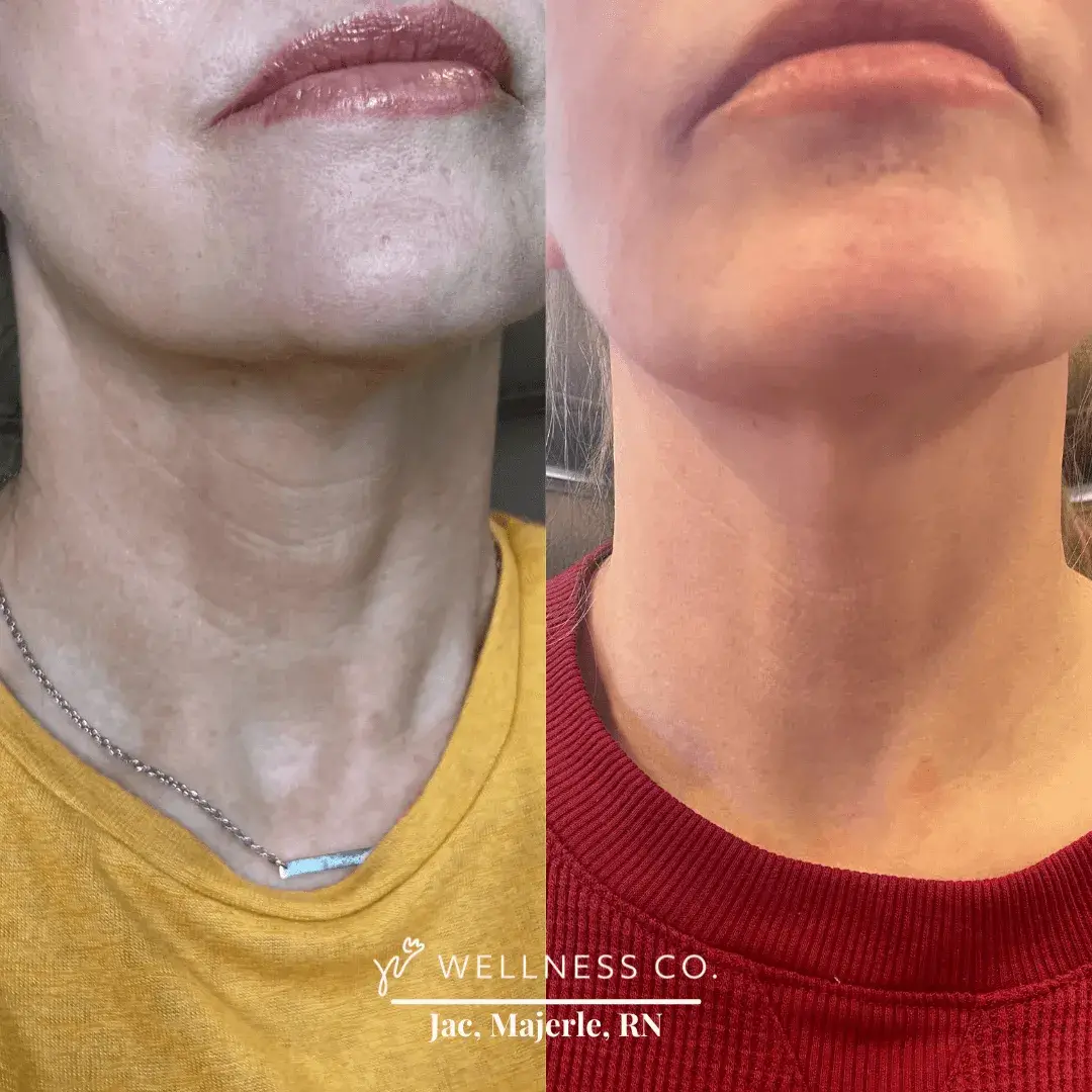 Before and after Photo | Radiesse for neck lines | Wellness Co. | Zeeland, MI
