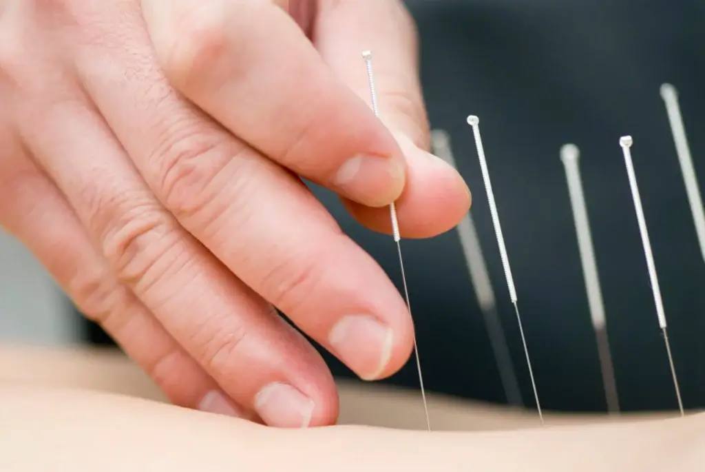 Acupuncture needles | Wellness Co | Zeeland MI